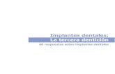 Implantes Dentales en Valencia