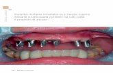 Implantes múltiples inmediatos en el maxilar superior mediante cirugía guiada y prótesis fija CAD-CAM. A propósito de un caso.