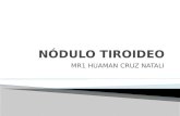 Nódulo tiroideo