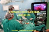 Laparoscopica hernia inguinal ppt.....