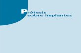 Prótesis sobre implantes -   · PDF filepilares e implantes dentales para rehabilitaciÓn protÉsica 1. osteointegraciÓn y materiales de los implantes..... 13 objetivos