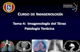 Tema 4: Imagenología del Tórax Patología Torá rax... · PDF fileReconocimiento de los siguientes patrones: Aumento de la densidad pulmonar Derrame pleural Neumotórax Tumores