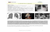 La imagen de la semana III - · PDF file(absceso de pulmón, empiema pleural, hemotórax, ... Microsoft Word - La imagen de la semana III.doc Author: Administrador Created Date: 12/2/2010