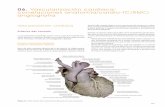 06. Vascularización cardíaca: correlaciones anatomía ... · gina las siguientes ramas: • Rama del cono arterial (ramus coni arteriosi). ... recho, tras introducirse en la trabécula
