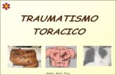 TRAUMATISMO TORACICO - reanimovil.comreanimovil.com/Media/reanimovil/dayvo/pdf/TEMAS GENERALES... · colapsar el pulmón,comprimir y desviar corazón,grandes vasos y traquea Hemotórax:
