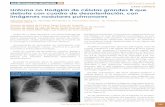 CASO CLÍNICO Linfoma no Hodgkin de células …mgyf.org/wp-content/uploads/2017/revistas_antes/V2N8/V2N8_249_252… · pruebas funcionales respiratorias fueron normales en 74,7 %