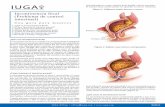 Incontinencia fecal (Problema de control intestinal) · • Personas que sufren de enfermedad inflamatoria intestinal (colitis) ... una cirugía en su colon (una parte del ... y la
