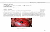Imagen del mes Lesión duodenal en paciente con hemorragia ...gastrolat.org/DOI/PDF/10.0716/gastrolat2014n400010.pdf · otras el aneurisma micótico, procesos inflamatorios circundantes,
