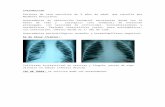 Introducción - AAMR · Web viewSecuencia Radiografías de Tórax en períodos sintomáticos Dilatación esofágica hipotónica, Más allá de los procesos de consolidación alveolar,