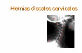 Hernias discales cervicales...de la termoablación intradiscal por padecer hernia discal “blanda”, generalmente se trata de deportistas y de accidentados de circulación. Las hernias