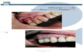 UtilizaciónClínicadel InjertoÓseoMejoradoPepGenP-15 · fondo de bolsa periodontal 7 mm y profundidad de la bolsa de 5 mm) (fig. 1). Respecto a la etiología de la lesión, además