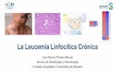 La Leucemia Linfocítica Crónica · “Historia” de la LLC Velpeau , 1827. Primera autopsia Virchow, 1847. Leucemia linfoide y mieloide. Minot y Isaacs, 1924. Descripción historia
