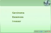 Carcinoma Escamoso Invasor - Ministério da Saúdebvsms.saude.gov.br/bvs/palestras/cancer/carcioma... · Carcinoma . Microinvasor. 10. 34.5. Carcinoma. Escamoso. Invasor. 3. 10.4.