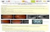 VASCULITIS RETINIANA COMO PRIMERA MANIFESTACIÓN DE …€¦ · !Hay mayor incidencia de alteraciones del SNC en LES con vasculitis retiniana (similar patogenia). VASCULITIS RETINIANA
