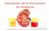 Evaluación de la Hematuria en PediatríaDolor en flanco con fiebre y síntomas miccionales (PNA) Temporalidad de la hematuria durante la micción. Color de la orina. Infecciones respiratorias