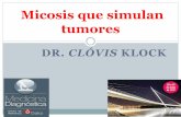 Micosis que simulan tumores€¦ · Micosis que simulan tumores. GLIOMA. Sistema Nervoso Central e Rinocerebral