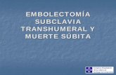EMBOLECTOMÍA SUBCLAVIA TRANSHUMERAL Y MUERTE SÚBITAsgacv.es/arquivos/pdfs/Embolectomia_transhumeral_y... · simplicidad de la técnica de embolectomía hace que olvidemos su potencialidad