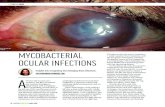 MYCOBACTERIAL OCULAR INFECTIONS · left eye, a deep infiltrate with a fluffy appearance, a small overlying corneal epithelial defect, 1 mm hypopyon, and what appeared to be superior