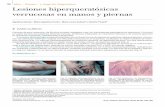 128 Lesiones hiperqueratósicas verrucosas en manos y piernas · desarrollo de cuernos cutáneo, queratoacantoma e incluso malignización a carcinomas epidermoides y carcinomas de