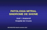 PATOLOGIA MITRAL SINDROME DE SHONE · • Produce insuficiencia mitral severa • Mecanismo: restricción en sístole de P2 tipo III b de Carpentier Partial Hammock Valve: Surgical