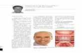 Sistema Lingual Incognito extracciones dentales