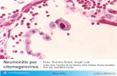 Neumonitis por Dres. Romina Notari, Angel Leal citomegalovirus