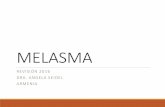 MELASMA - AsoColDerma