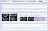Metástasis craneal de carcinoma urotelial