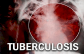Tuberculosis pulmonar