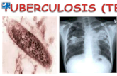 Tuberculosis (tb)